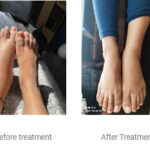 Ayurveda Management for Lymphedema